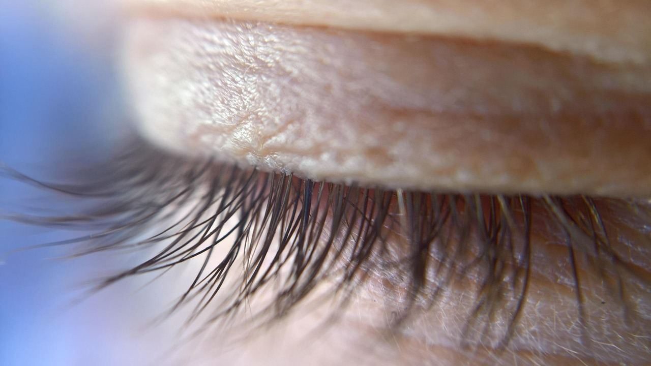 Eyelid margin and eyelashes close-up